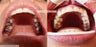 Full Denture Makeover