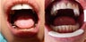 Full Denture Makeover