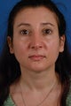 Revision rhinoplasty patient after 2 prior rhinoplasties