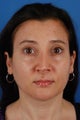 Revision rhinoplasty patient after 2 prior rhinoplasties