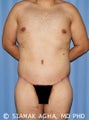 28 Year Old Male Body Lift