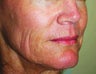 Fractional CO2 Laser