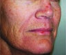 Fractional CO2 Laser