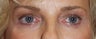 Female Eyelid Surgery with Brow Lift
