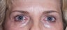 Female Eyelid Surgery with Brow Lift