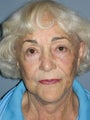 LiteLift™ and Blue Peel® on 79-year-old Woman