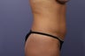42 yr old wanting a mommy makeover