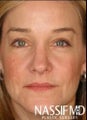 Female Primary Rhinoplasty