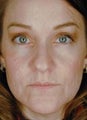 Female Primary Rhinoplasty
