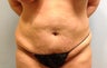 Tummy Tuck