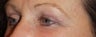 Female with Eyelid Surgery