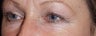 Female with Eyelid Surgery