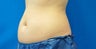 Liposonix
