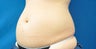 Liposonix