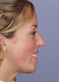 Female Chin Implant