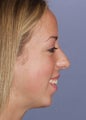 Female Chin Implant