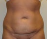 Mini Tummy Tuck