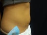 Coolsculpting