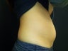 Coolsculpting