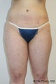 Liposuction