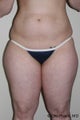 Liposuction