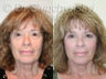 Upper and Lower Blepharoplasty, SLUPlift mini-facelift