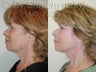Upper and Lower Blepharoplasty, SLUPlift mini-facelift