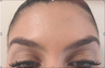 Botox Brow Lift