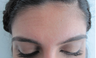 Botox Brow Lift