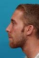 Chin Implant