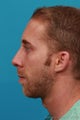 Chin Implant