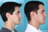Revision Rhinoplasty