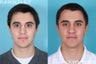 Revision Rhinoplasty