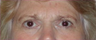 Blepharoplasty