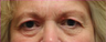 Blepharoplasty