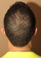 Hair transplantation using Neograft - crown coverage