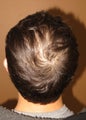 Hair transplantation using Neograft - crown coverage