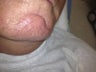 66 yo male with chin veins