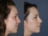 Before & After Laser Resurfacing