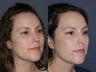 Before & After Laser Resurfacing