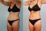 Tummy Tuck: 31-Year-Old Woman