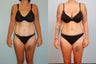 Tummy Tuck: 31-Year-Old Woman