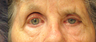 Functional Brow Lift, Canthoplasty, Gold Weight Placement