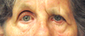 Functional Brow Lift, Canthoplasty, Gold Weight Placement
