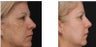 Melasma and Age Spots Improve Significantly with the correct bleaching cream regimen / combination