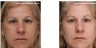 Melasma and Age Spots Improve Significantly with the correct bleaching cream regimen / combination