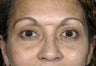 Upper and lower lid rejuvenation