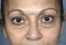 Upper and lower lid rejuvenation