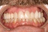 53 Year Old Male gets Smile Makeover