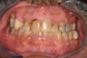 53 Year Old Male gets Smile Makeover
